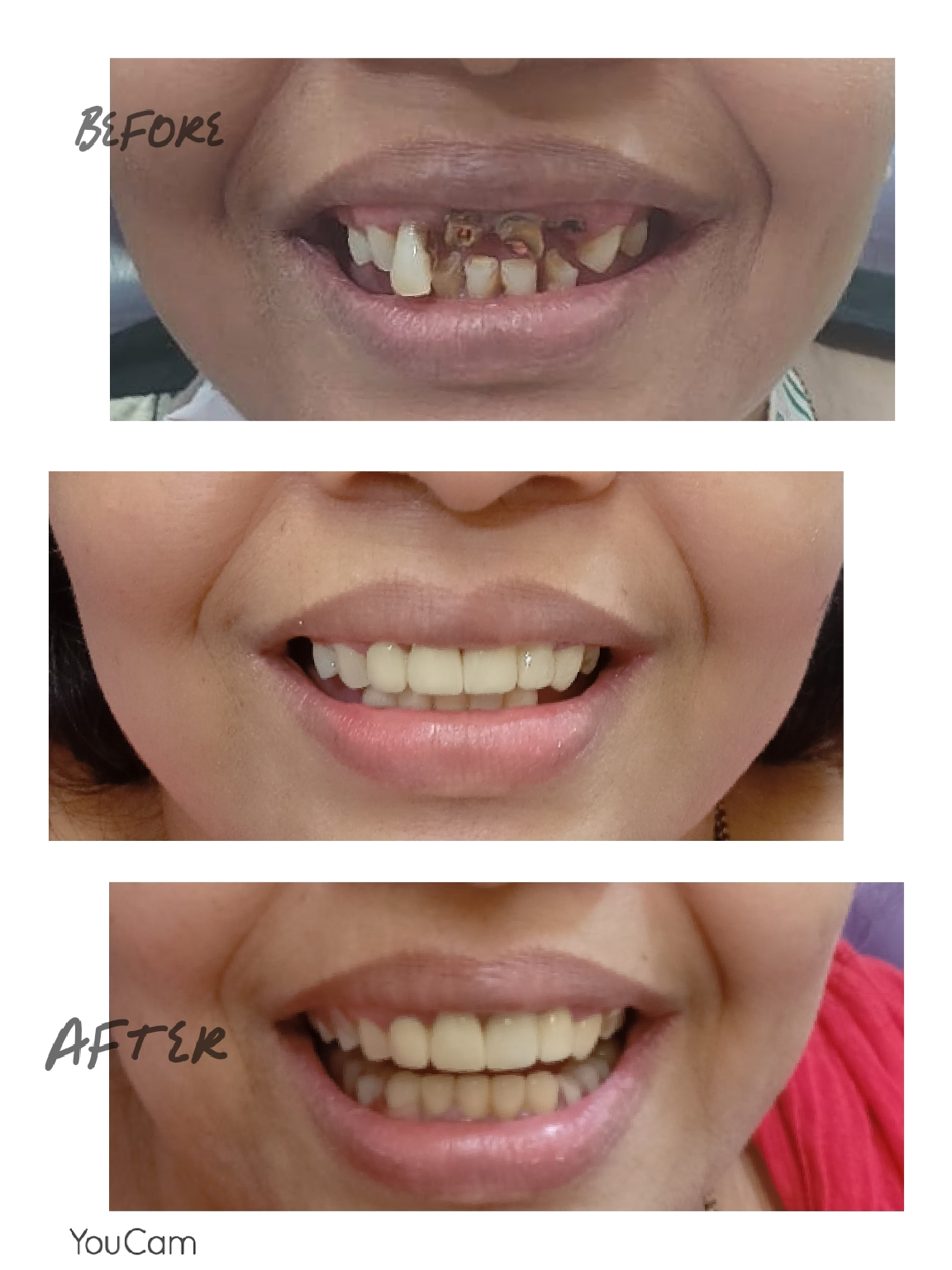 Smile Transformation 3